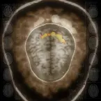 Pochette Corpus Callosum