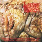 Pochette Malignant Cancerous Tumor in the Epitelial Tissue of the Intestine