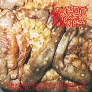 Pochette de Malignant Cancerous Tumor in the Epitelial Tissue of the Intestine de Lymphatic Phlegm